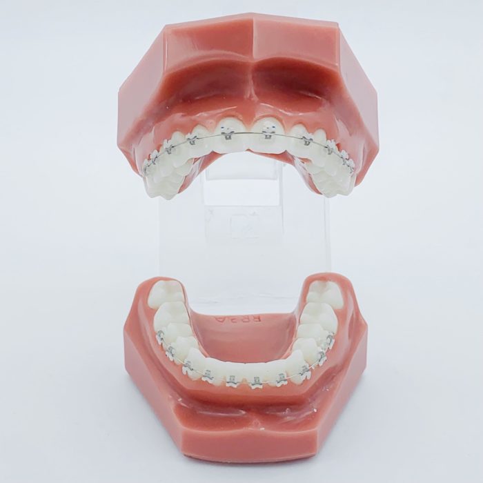 Aligneurs dentaires et alignement dentaire à Lyon